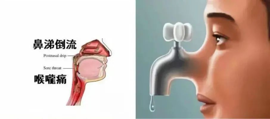 【鼻炎】“鼻涕倒流”不一定是鼻涕分泌太多，很可能是因为这些！(图3)