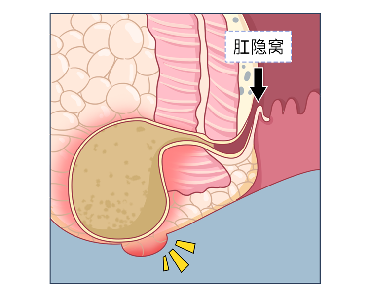 肛周脓肿早期症状图片图片